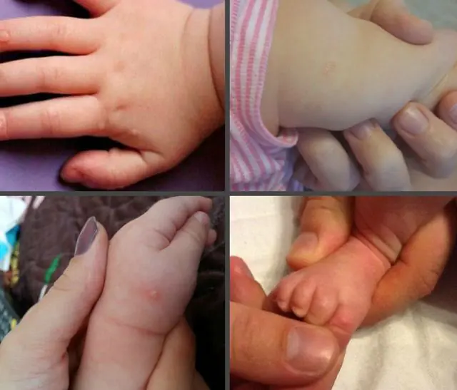 What do warts look like in newborns?