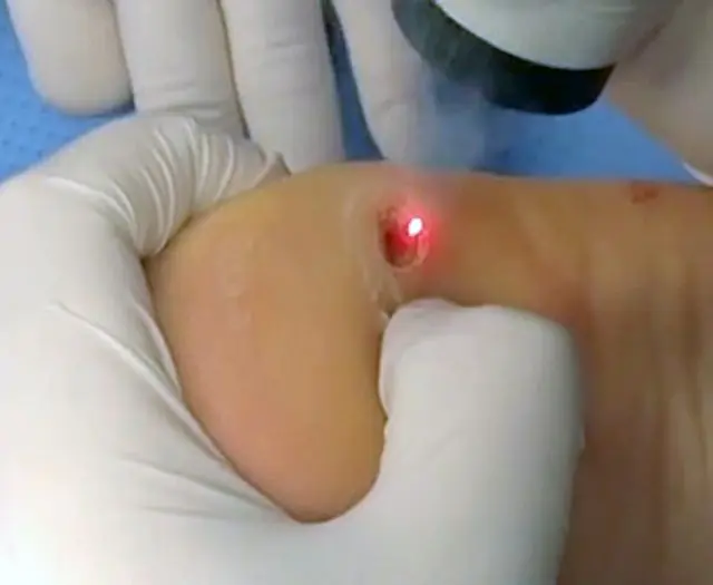 Removing warts on heels