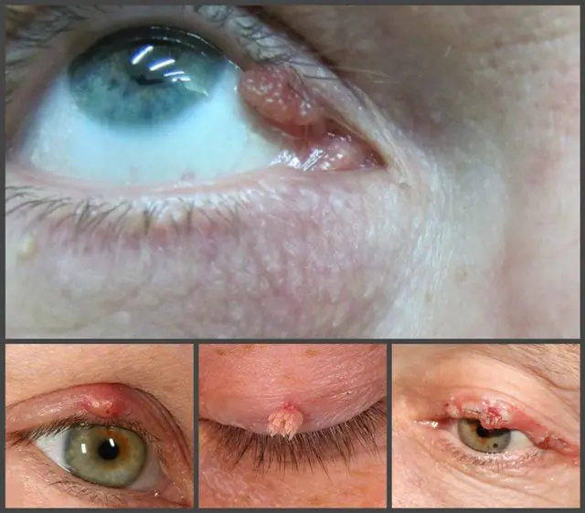 Papillomas on the upper eyelid