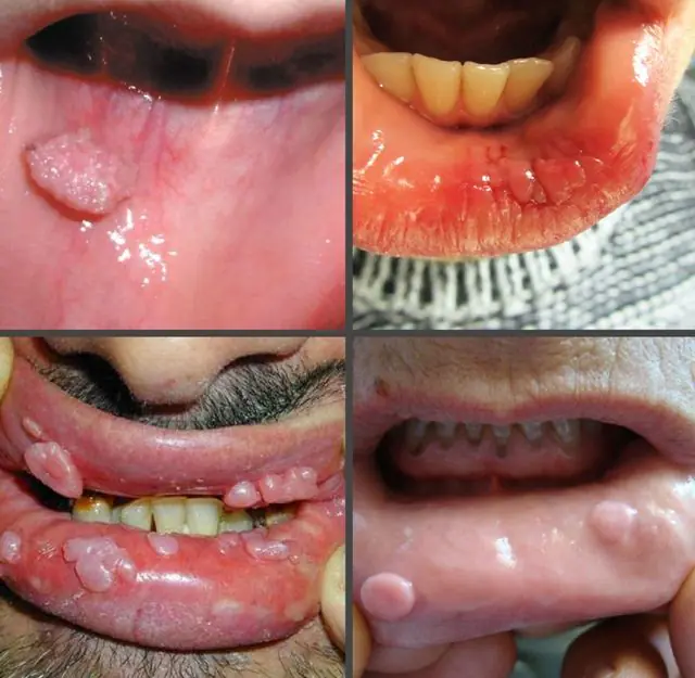 What do papillomas look like on the inside of the lip?