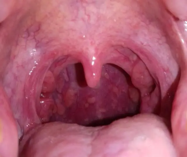 Papillomas in the throat