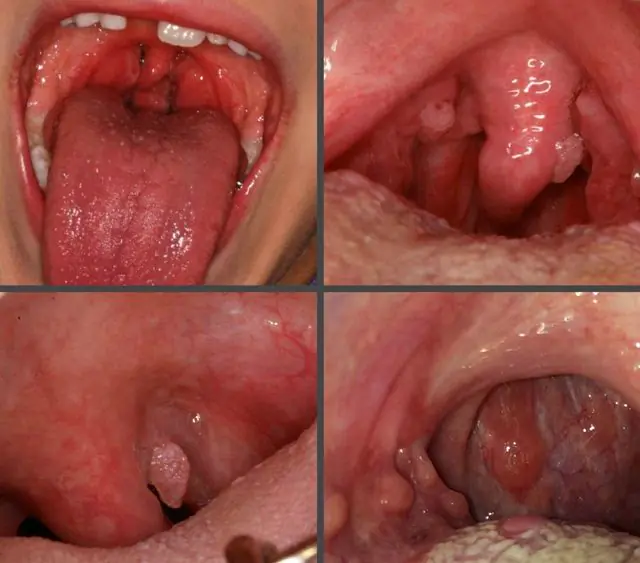 What do papillomas in the throat look like in children?