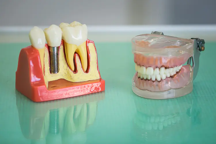 Dental implantation: indications, stages