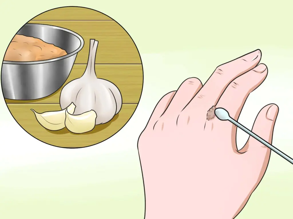 How to Remove Warts: Home Remedies and Professional Treatment