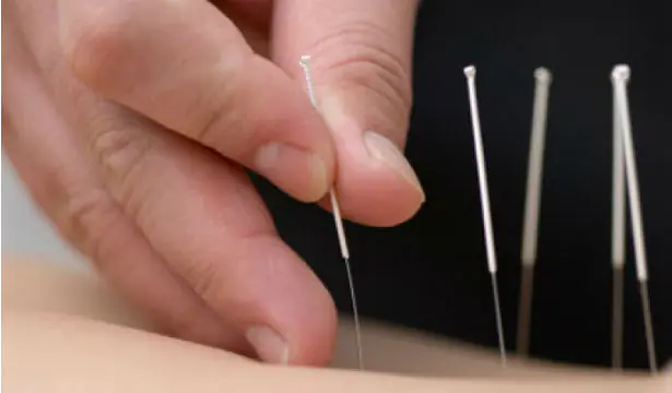 How to fight the blues: acupuncture