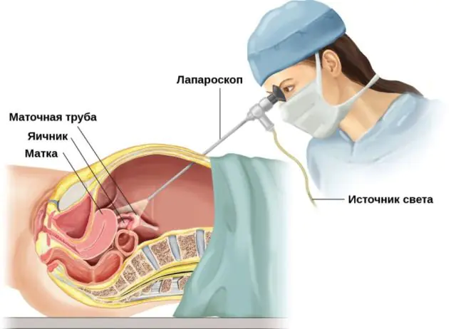 付属器炎の治療のための腹腔鏡検査