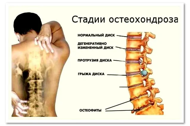 Stades de l'ostéochondrose sous l'omoplate gauche