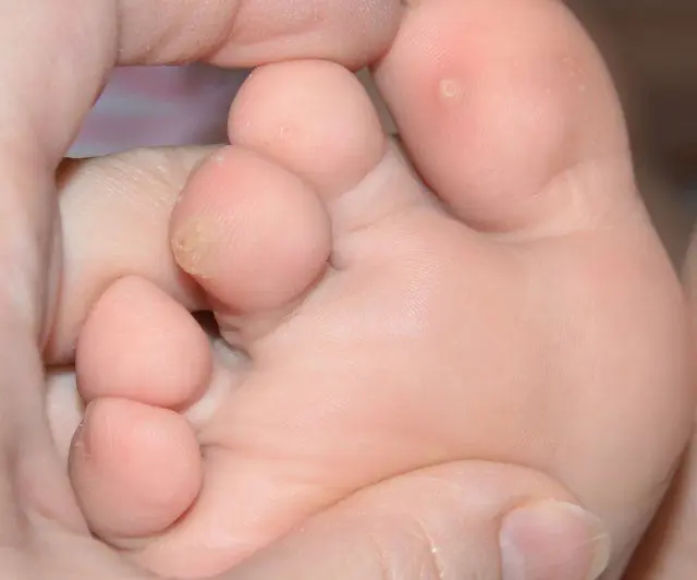 Verruga entre os dedos dos pés de uma criança