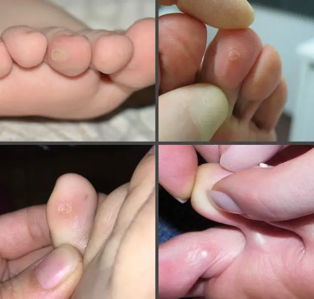 Hoe zien wratten tussen de tenen van een kind eruit?