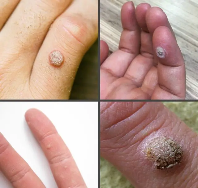 ¿Cómo se ven las verrugas en un dedo?