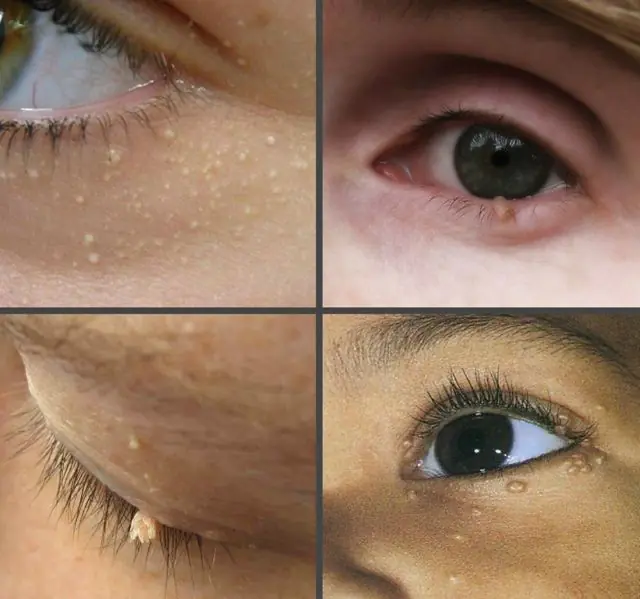 What do warts look like on a child's eyelid?