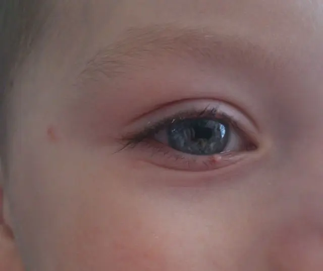 Syyliä lapsen silmäluomessa