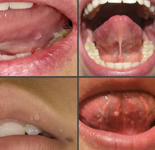 Como são as verrugas na boca de uma criança?