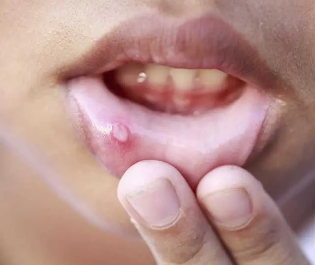 A wart in a child's mouth