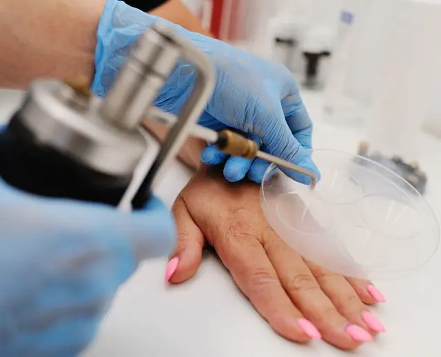 Cryodestruction of warts on hands
