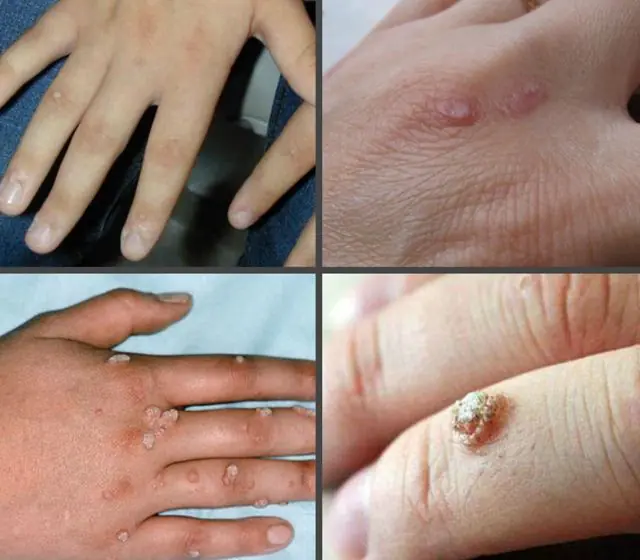 What do warts on hands look like?