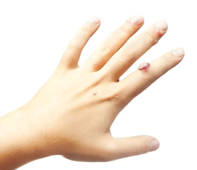 HPV sulle mani