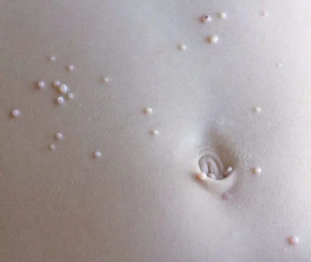 Warts on the stomach of a child