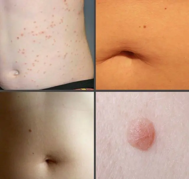 What do warts look like on a child's stomach?