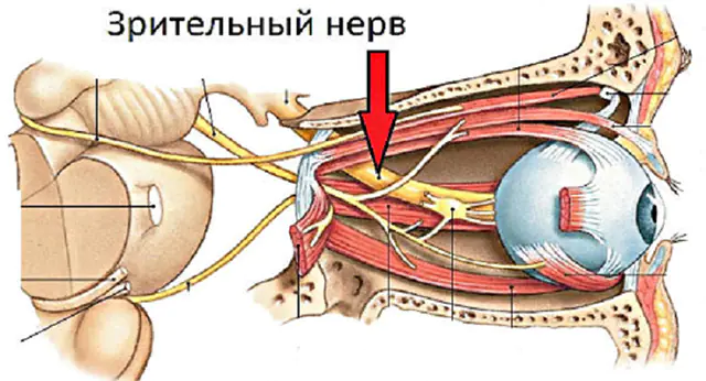 Inflamação do nervo óptico