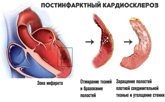 Kardioskleróza