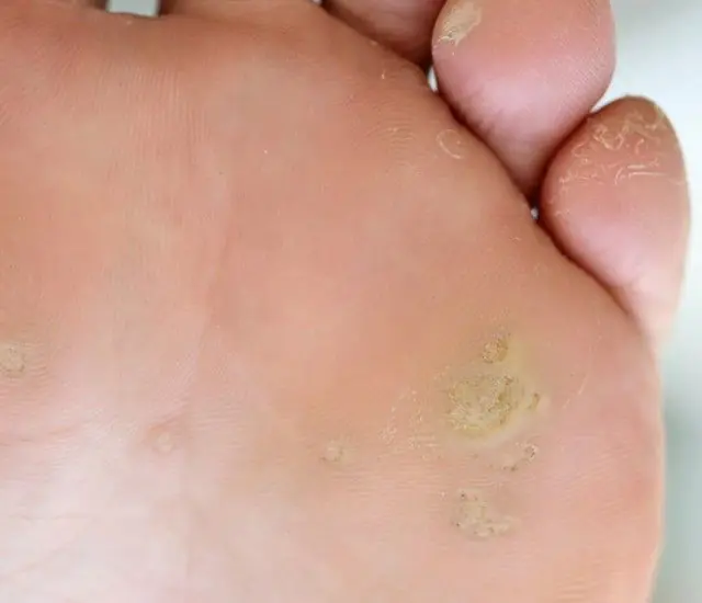 What does a plantar wart look like?