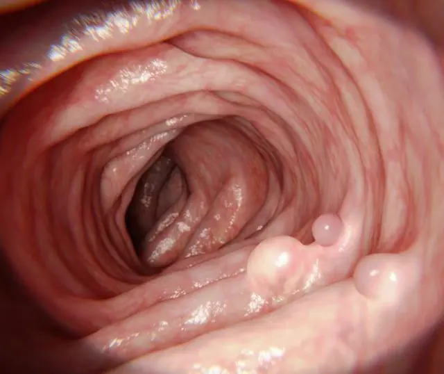 Polyps in the intestines