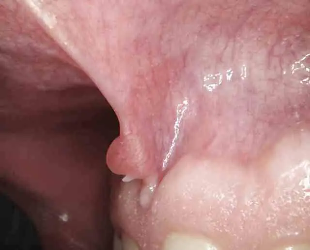 Papilloma della mucosa orale