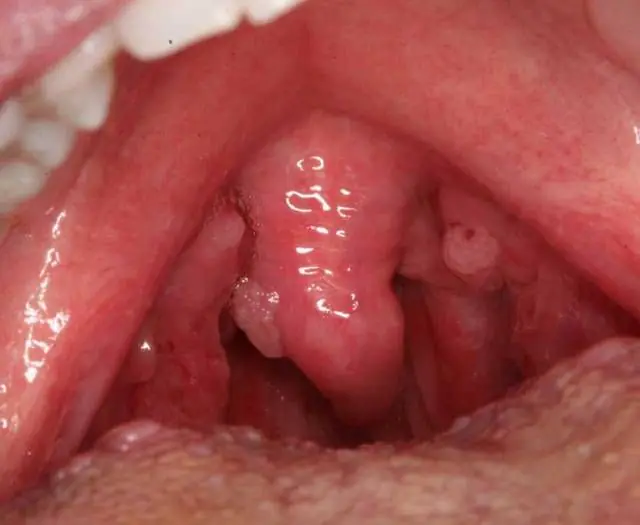 What is the difference between a polyp and a papilloma?