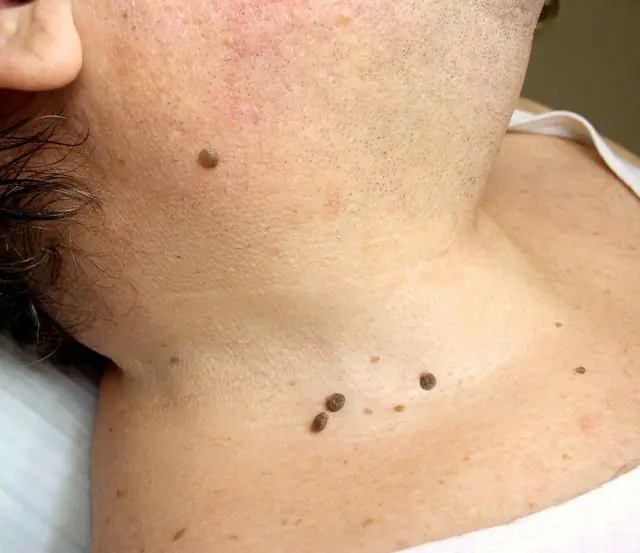 Spread of HPV in the neck