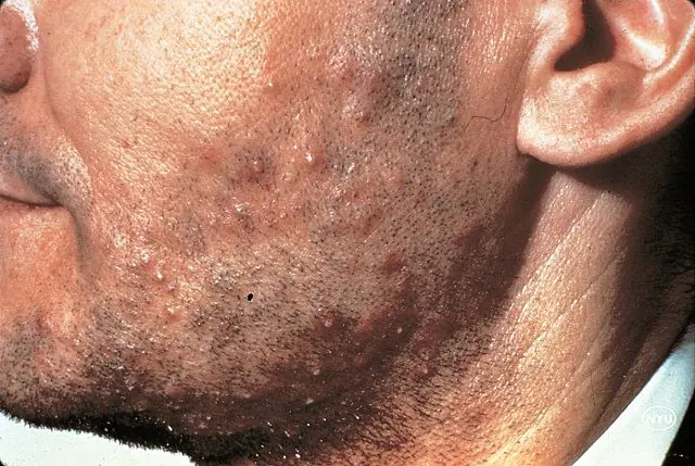 Folliculitis on the face