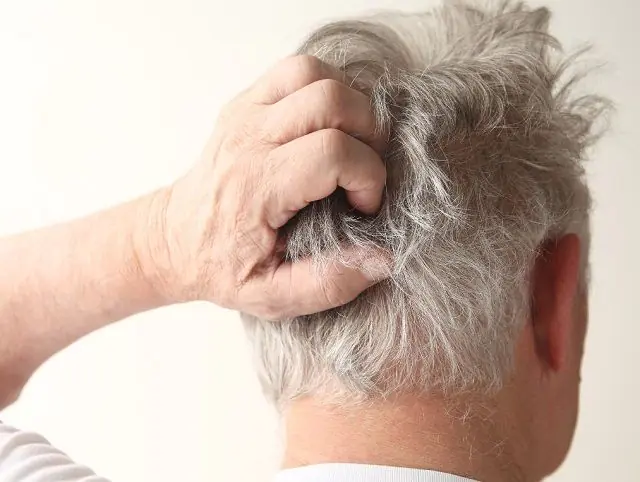 Itchy scalp due to folliculitis