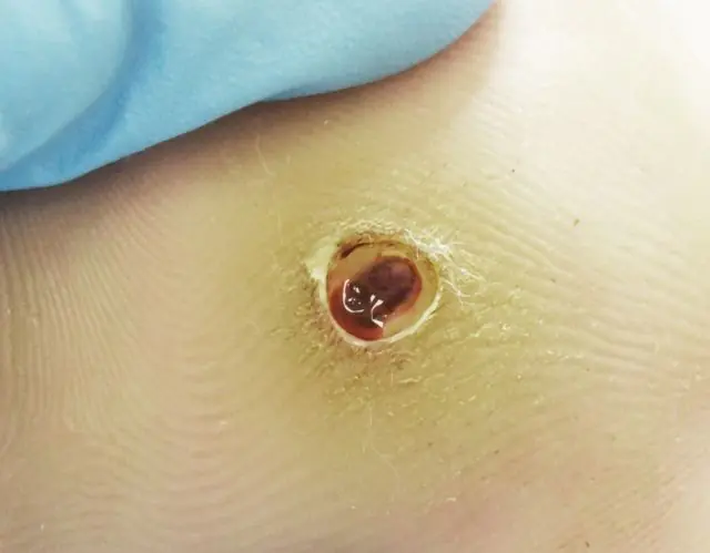 Papilloma burst on the body