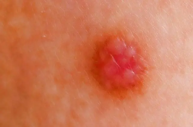 Inflamed papilloma