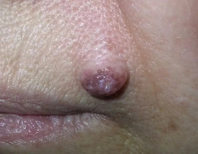 A woman's papilloma is swollen