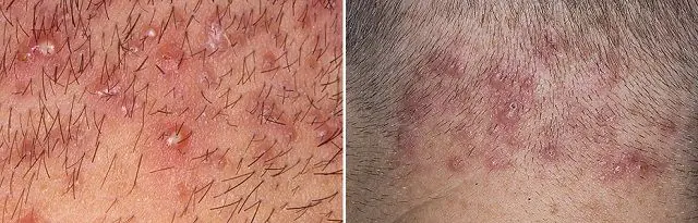 Overfladisk follikulitt på hårete områder av huden