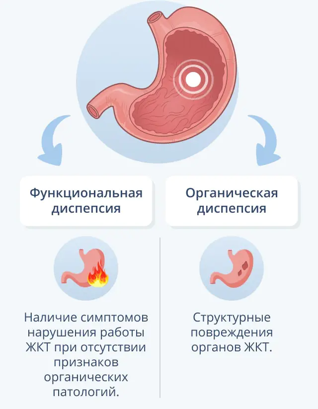 Types of dyspepsia – functional and organic
