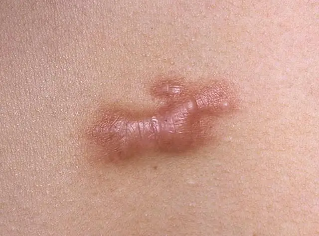Scar after removal of papilloma by electrocoagulation