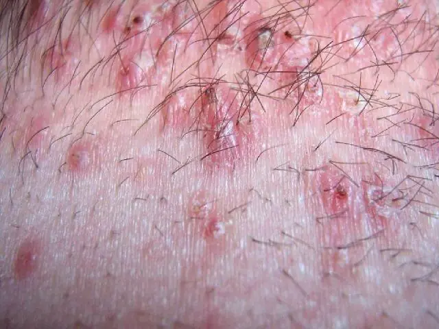 Zapalenie mieszków włosowych po masażu na skórze
