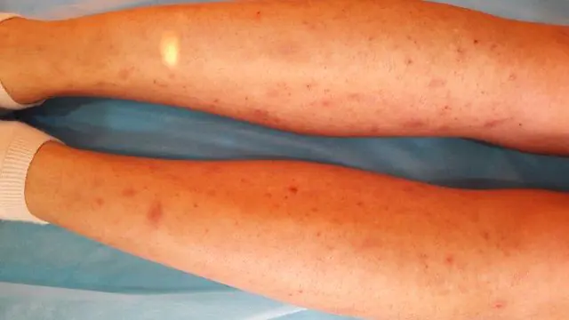 Folliculitis after sugaring on legs