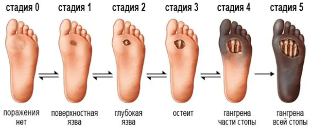 Stages of gangrene