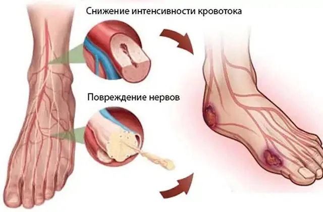 Prevention of gangrene