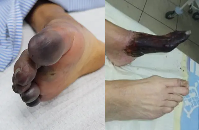 gangrena dos pés
