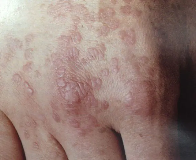 Warts as an indication for the use of Gepon