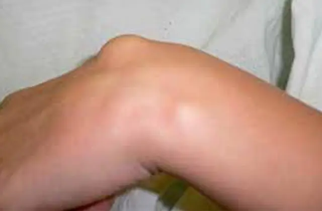 Hygroma på ett barns hand