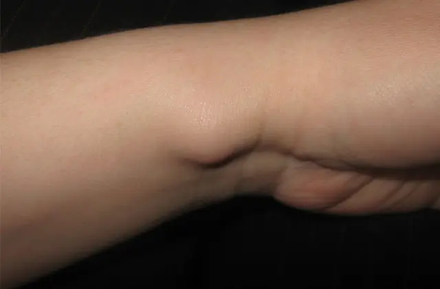 hygroma trên tay