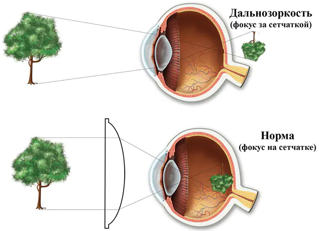 Hypermetropia in children - farsightedness
