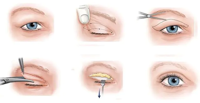Sebészeti beavatkozás a szemhéj chalazio esetén