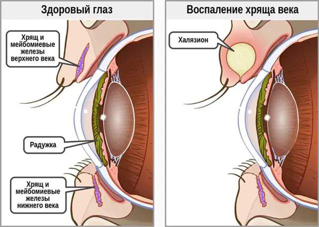 příznaky chalazionu očních víček