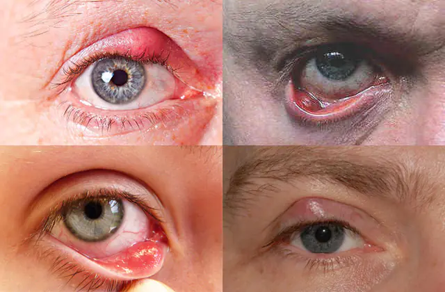 chalazion of the upper and lower eyelids
